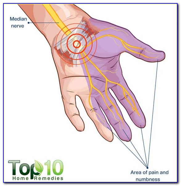 Carpal Tunnel Release Diagram