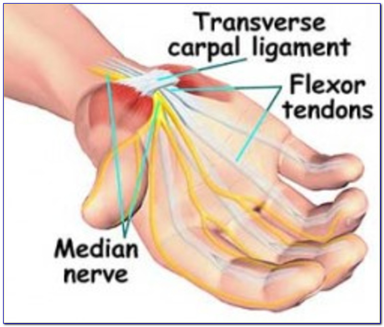 Carpal Tunnel Syndrome Diagram