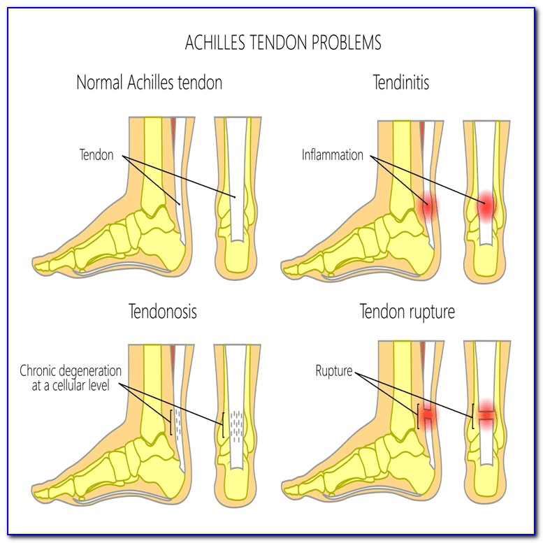 Achilles Tendon Injury Diagram
