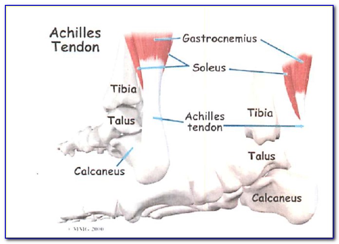 Achilles Tendon Pain Diagram