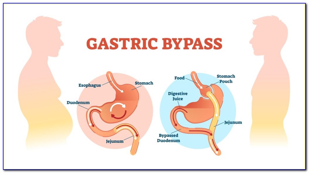 Gastric Bypass Surgery Diagram