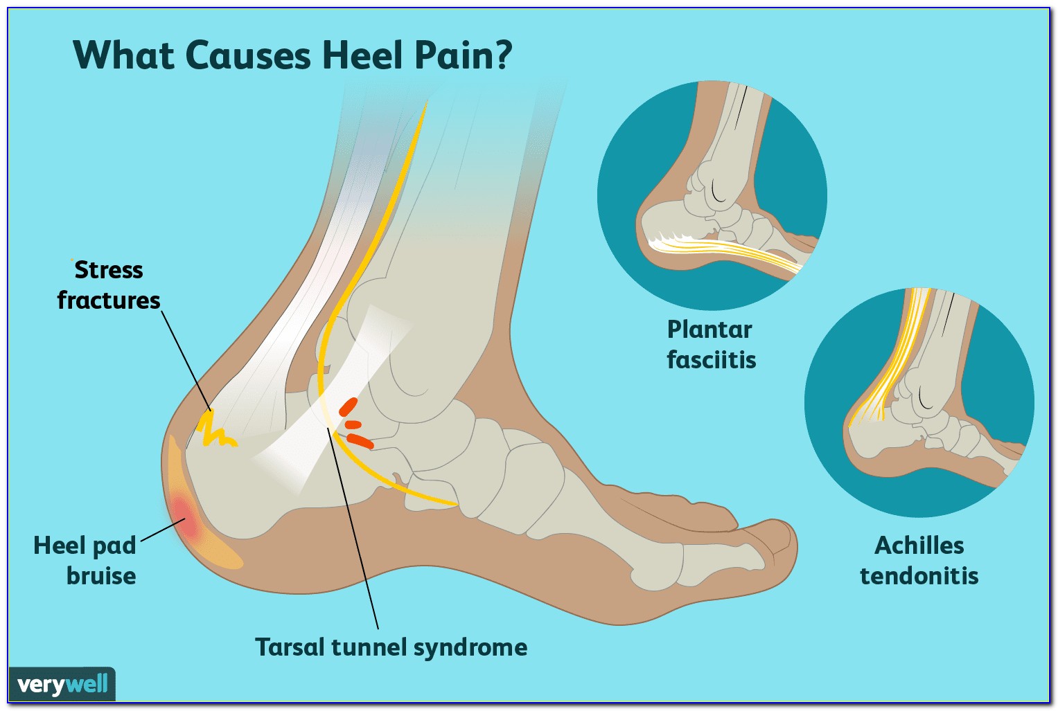 Heel Pain Causes Diagram