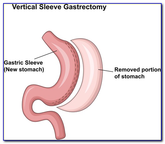 Mini Gastric Bypass Diagram