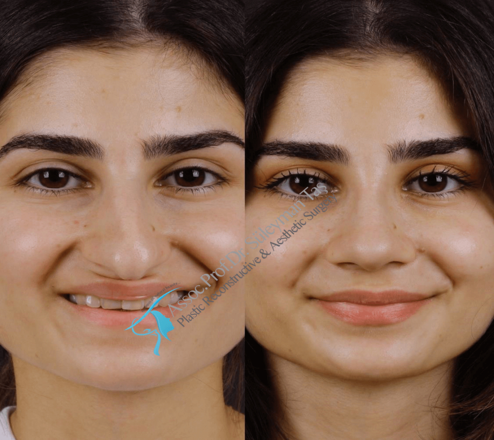 How much is the price of rhinoplasty?  Assoc. Prof. Dr